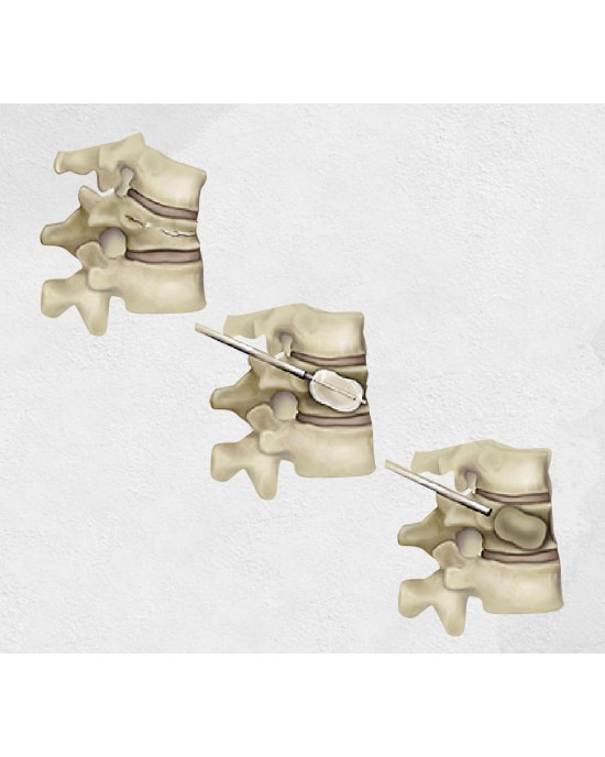 Kyphoplasty