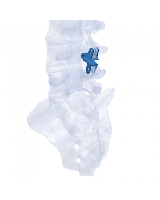 Interspinous Device